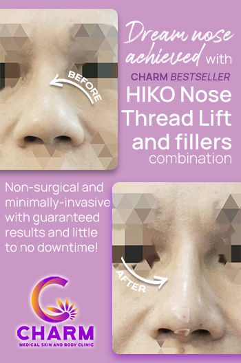 Charm Medical Skin & Body Clinic La Union - Services - Thread Non-Surgical Nose Lift Aesthetic Doctor